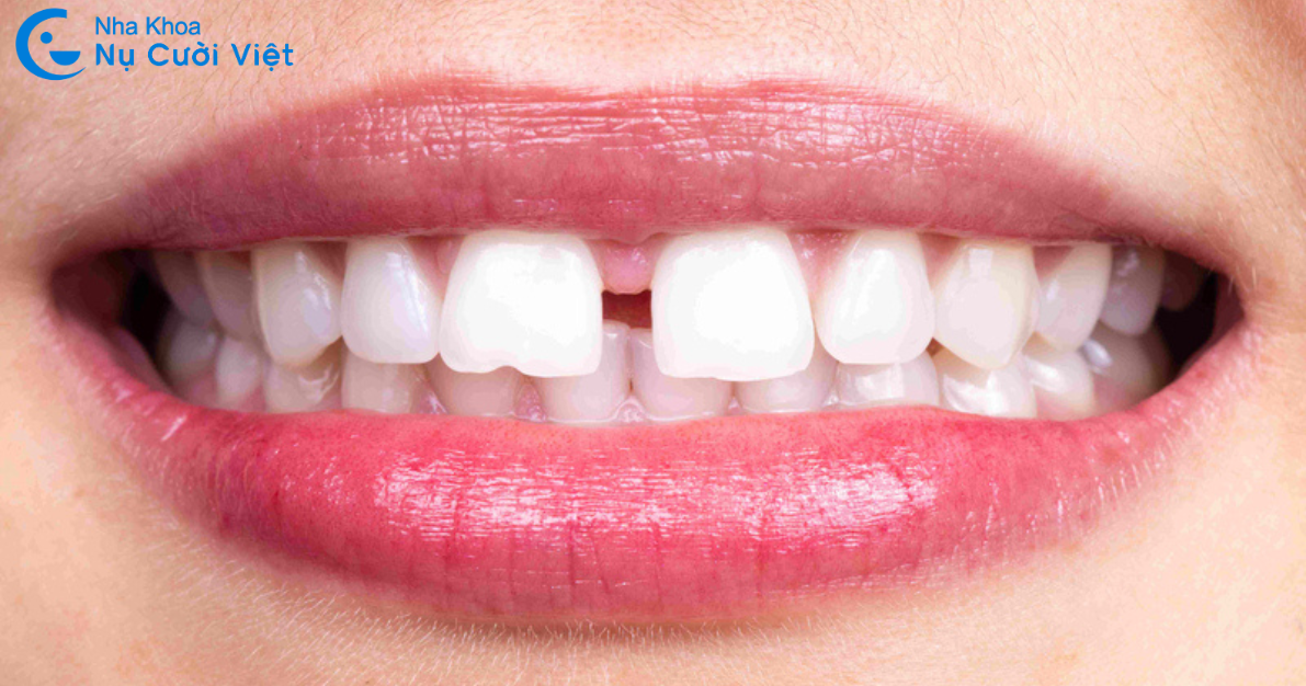 chỉ niềng 2 răng cửa bi thưa có được không