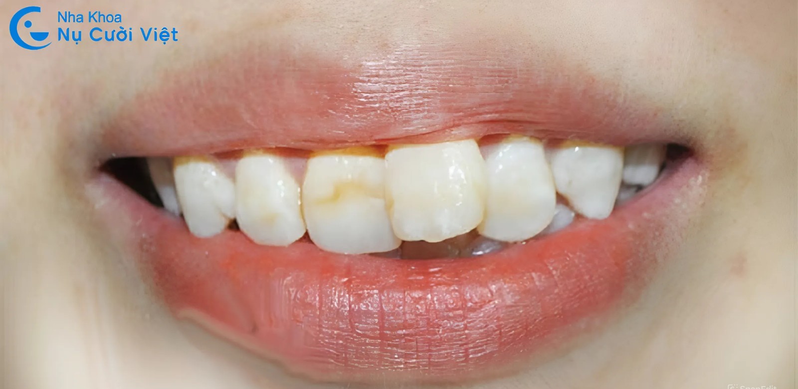 chỉ niềng 2 răng cửa bị lệch có được khong