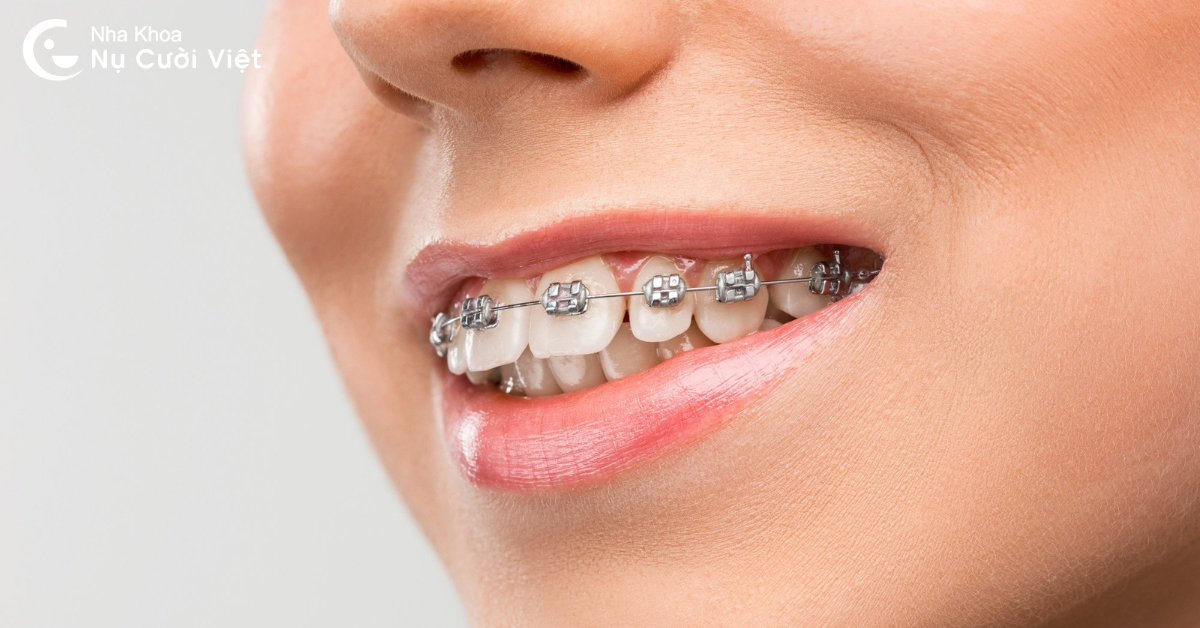 niềng 2 răng cửa với niềng răng mắc cài