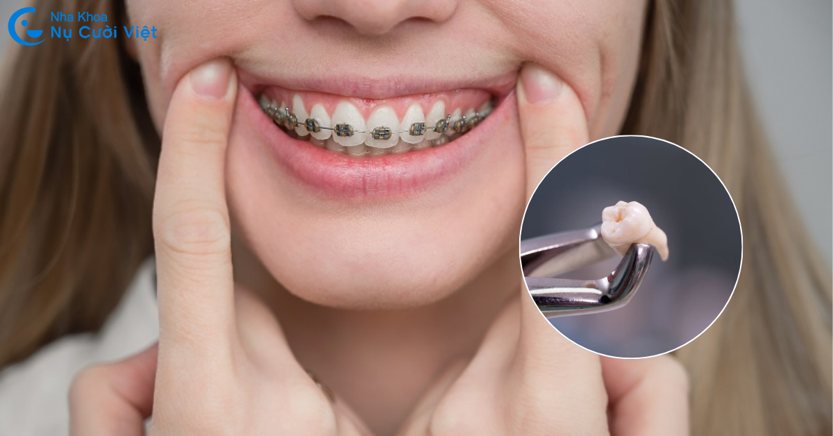 niềng răng có cần nhổ răng khôn không