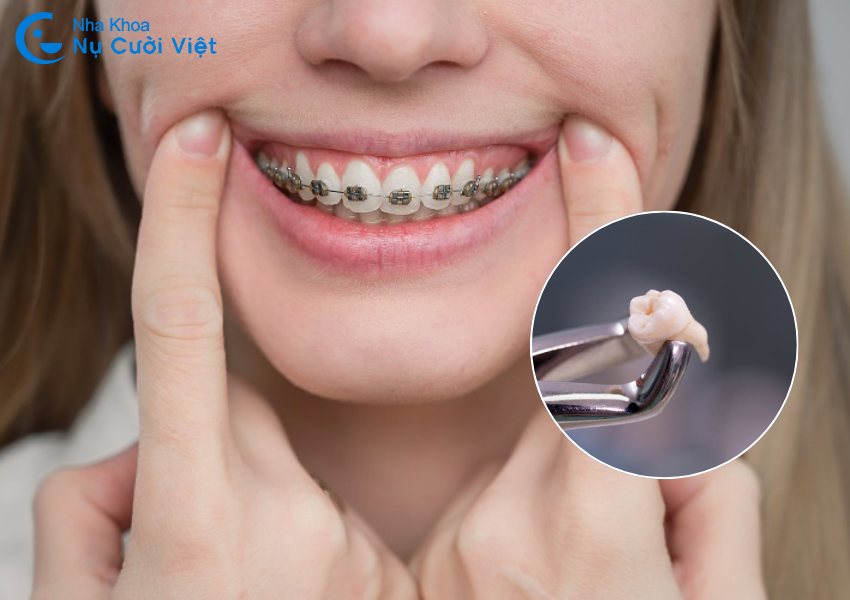 Nụ Cười Việt - Niềng răng có cần phải nhổ răng khôn không? Trường hợp nào cần nhổ