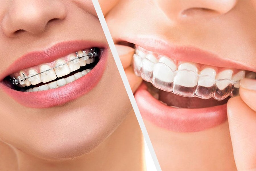 Nụ Cười Việt - Niềng răng Invisalign có đau không? Các yếu tố ảnh hưởng và mẹo giảm đau khi đeo khay trong suốt