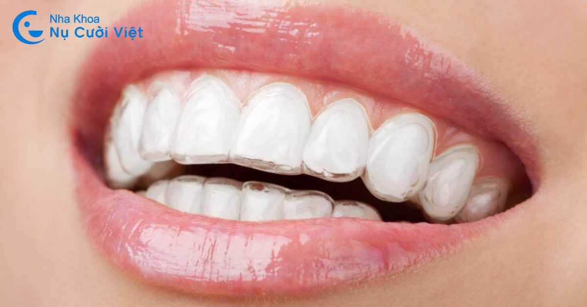 niềng răng invisalign có đau hơn mắc cài không