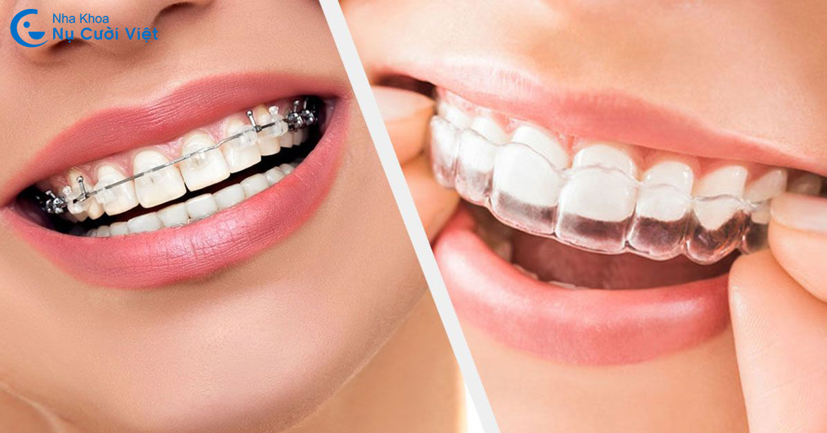 niềng răng invisalign có đau hơn mắc cài không nụ cười việt