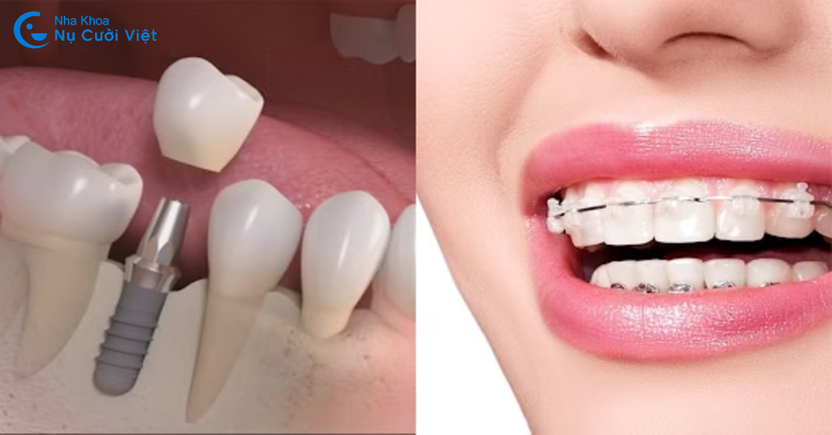 niềng răng kết hợp trồng implant