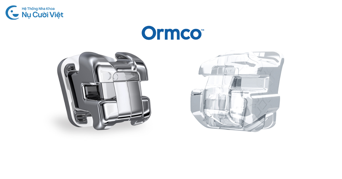 các loại niềng răng mắc cài damon