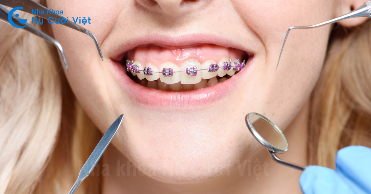niềng răng mắc cài trẻ em