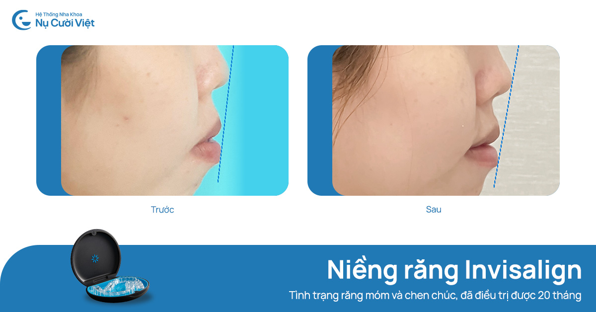 niềng răng thay đổi độ nhô của môi