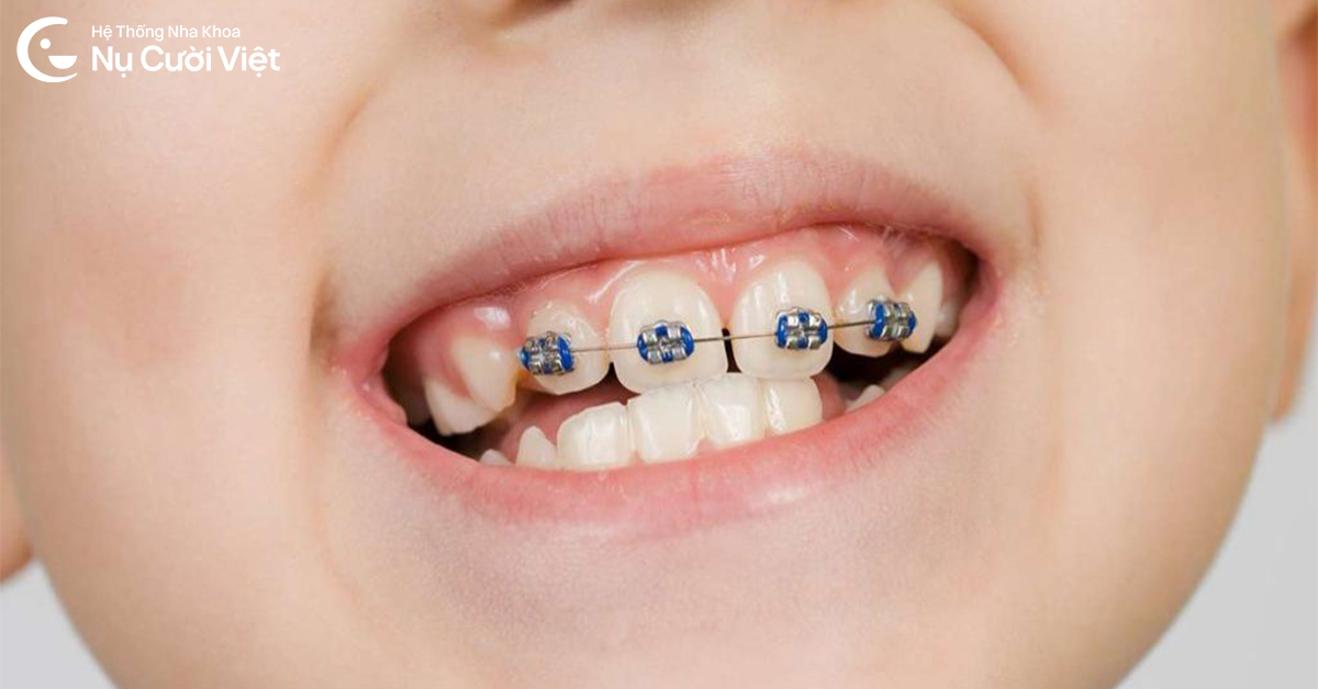 chi phí niềng răng mắc cài cho trẻ em