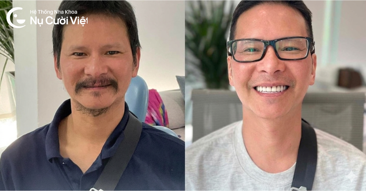 phục hình hàm tạm cấy ghép implant