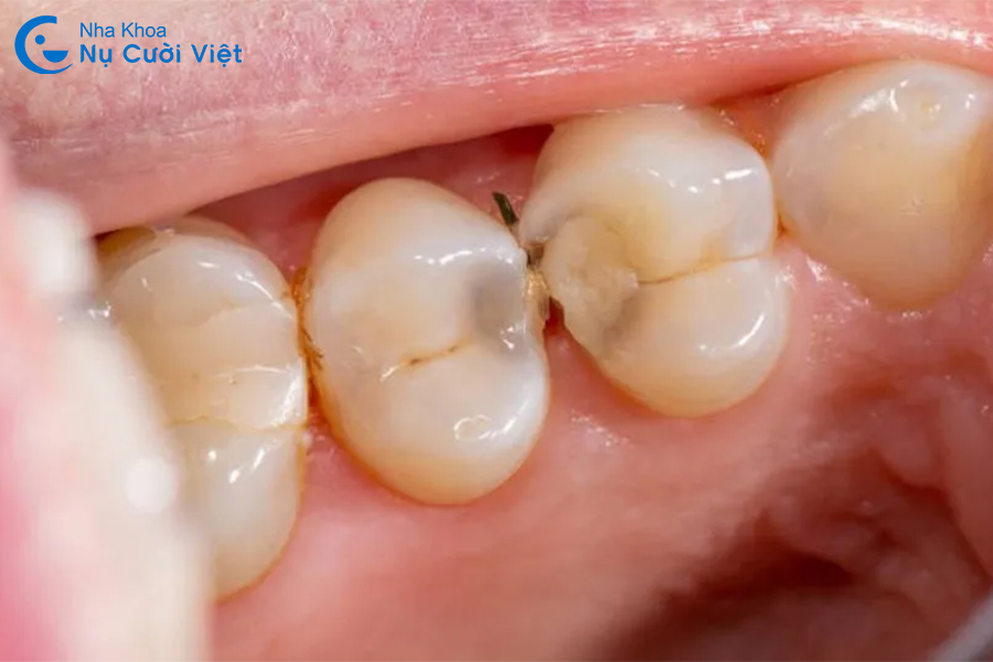Nụ Cười Việt - Nguyên nhân răng bị đen ở kẽ? Làm sao để xử lý và phòng ngừa hiệu quả