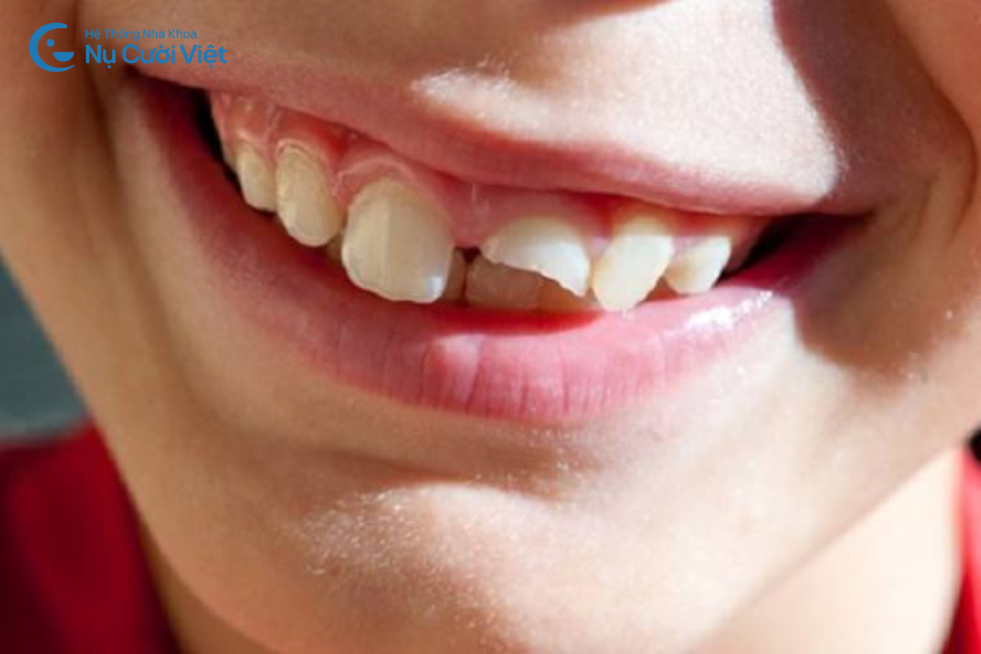 Nụ Cười Việt - Răng bị gãy ngang phải làm sao? Nguyên nhân và cách điều trị