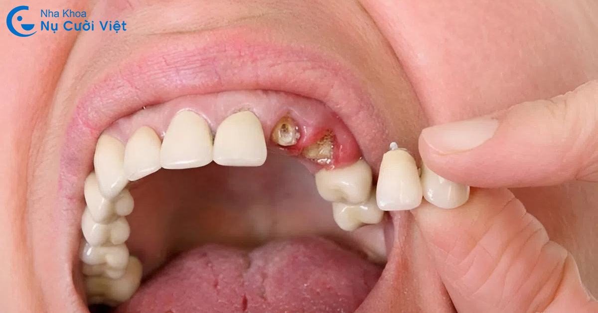hậu quả của răng sâu bị vỡ chỉ còn chân răng