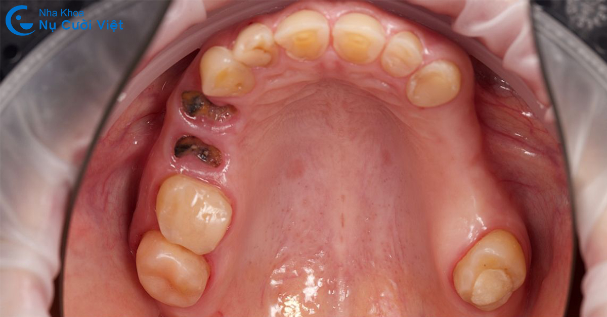răng sâu bị vỡ chỉ còn chân răng là gì