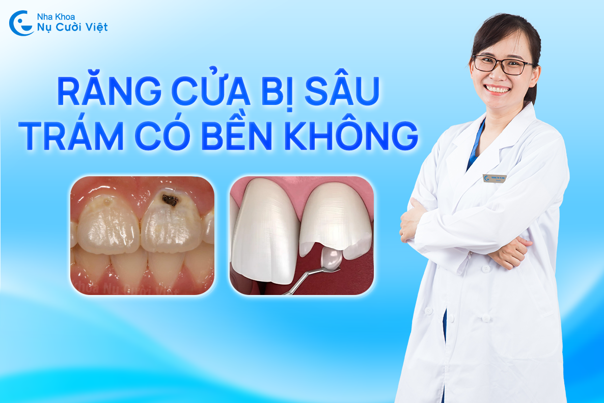 Nụ Cười Việt - TRÁM RĂNG CỬA SÂU CÓ BỀN KHÔNG? CHỌN VẬT LIỆU NÀO ĐỂ DUY TRÌ THẨM MỸ VÀ CHỨC NĂNG LÂU DÀI?