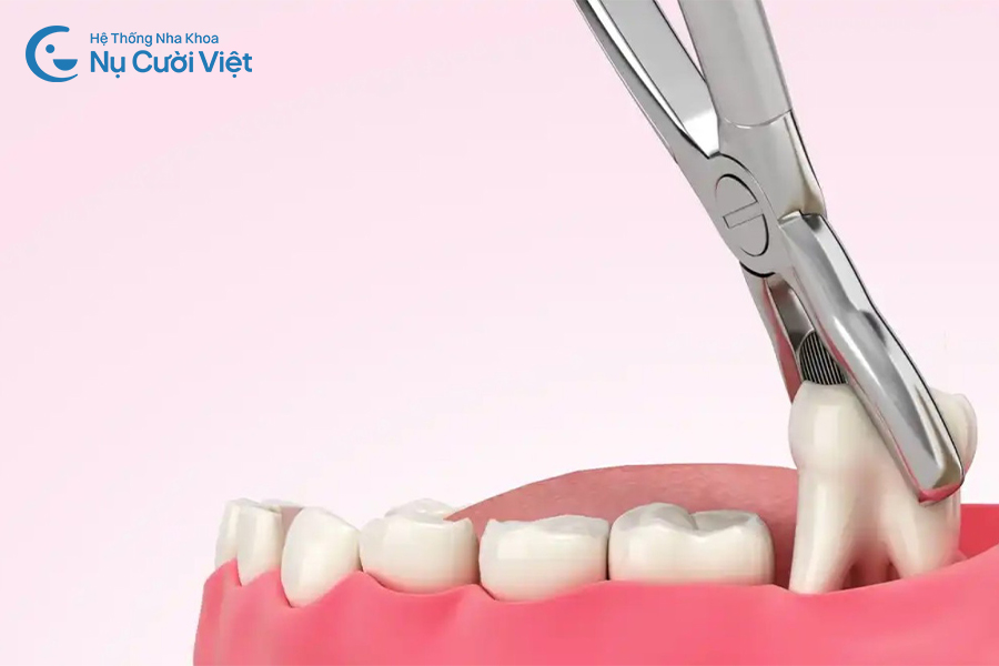 Nụ Cười Việt - Lợi đang sưng có nhổ răng khôn được không?