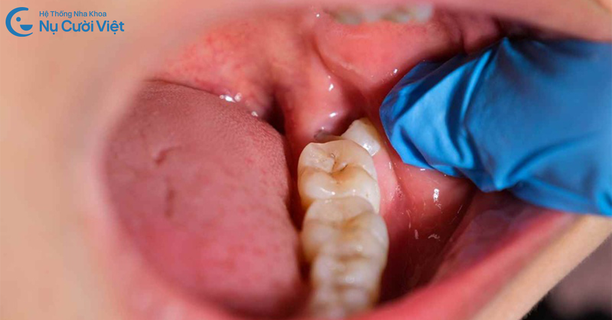 răng khôn đau nhức có nhổ được không