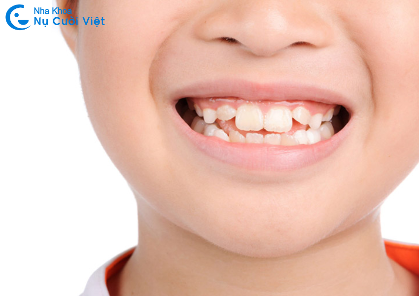 Nụ Cười Việt - Răng mọc lộn xộn thì nên chọn niềng răng hay bọc sứ?