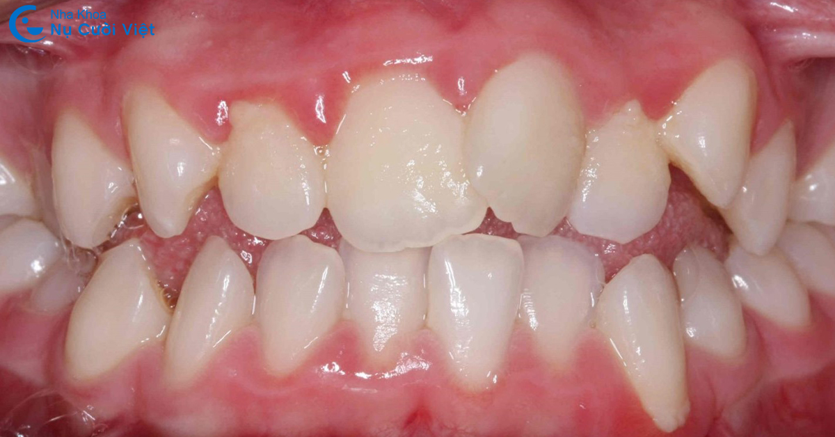 răng lộn xộn nên niềng răng hay bọc sứ