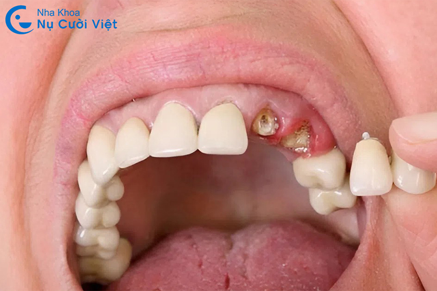 Nụ Cười Việt - Răng sâu bị vỡ chỉ còn chân răng: Dấu hiệu và cách điều trị dứt điểm