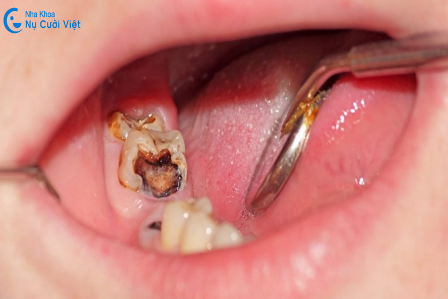 Nụ Cười Việt - TOP NHỮNG DẤU HIỆU NHẬN BIẾT RĂNG SÂU VÀO TỦY, CÁCH ĐIỀU TRỊ HIỆU QUẢ LÀ GÌ?