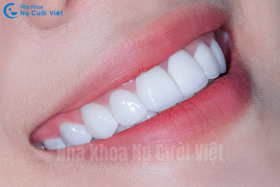 Nụ Cười Việt - RĂNG SỨ CÓ BỊ MÒN KHÔNG? NGUYÊN NHÂN & CÁCH KHẮC HIỆU QUẢ NHẤT