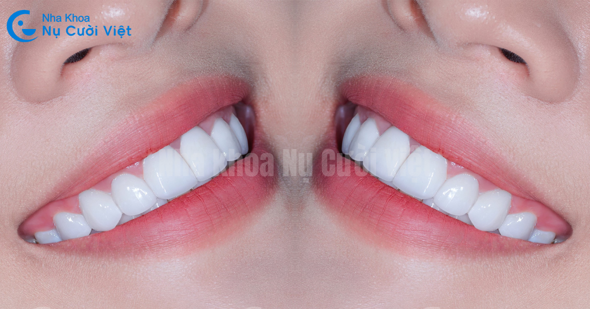 răng sứ có bị mòn không