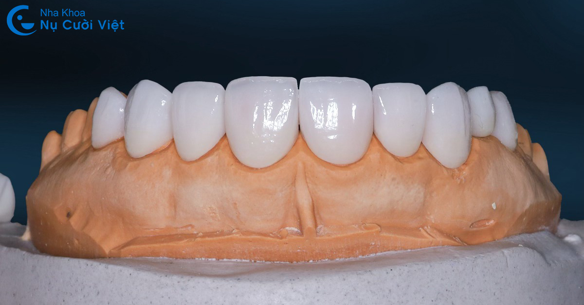 ưu điểm của răng sứ emax