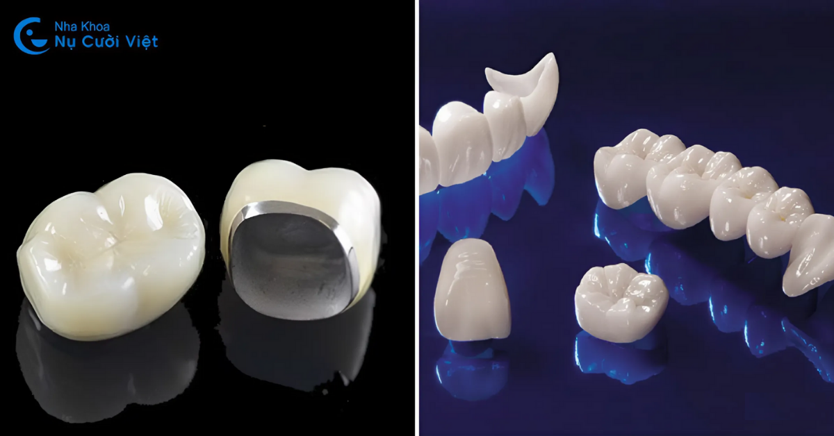 răng sứ kim loại và răng toàn sứ