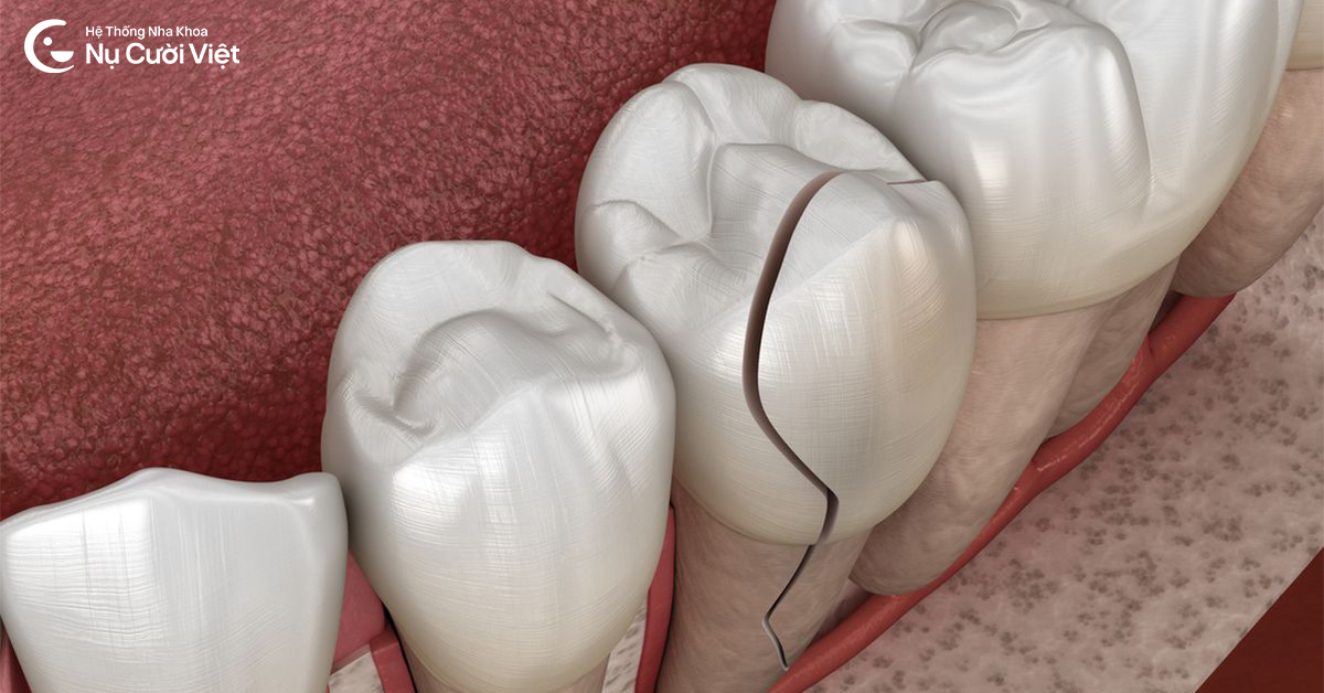 rủi ro niềng răng sau bọc sứ