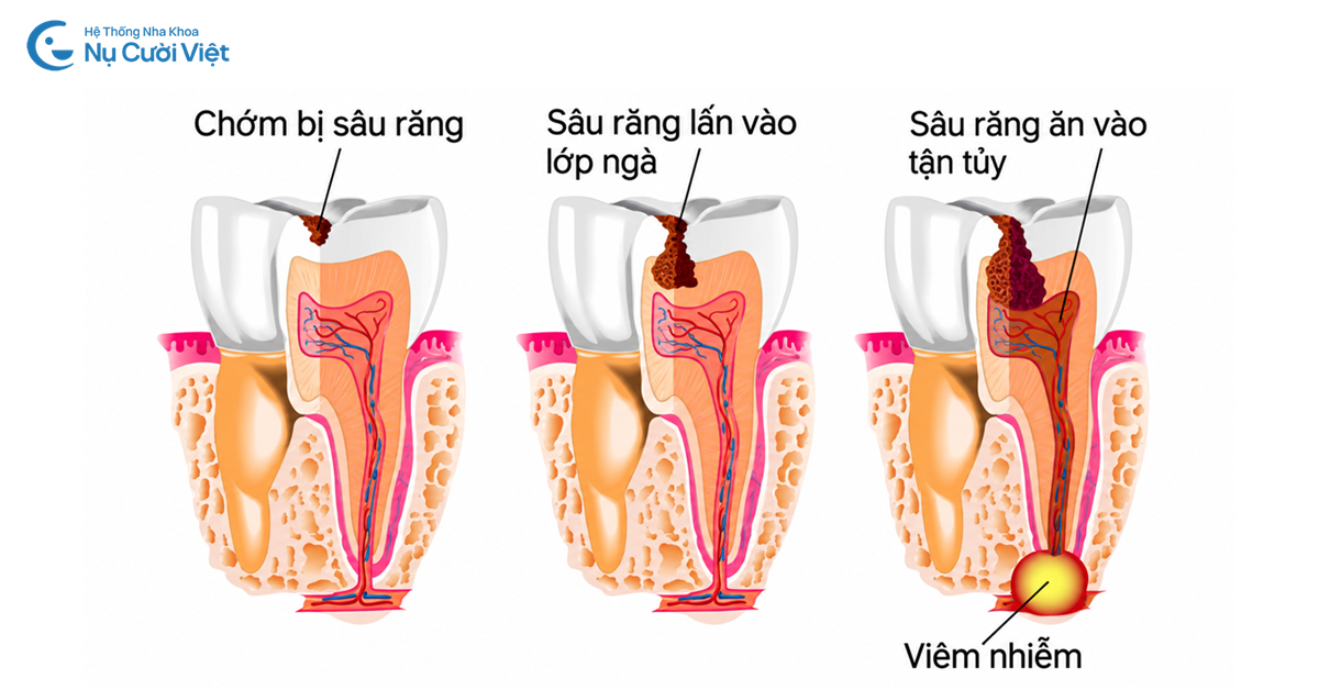 sâu răng gây viêm tủy đau nhức