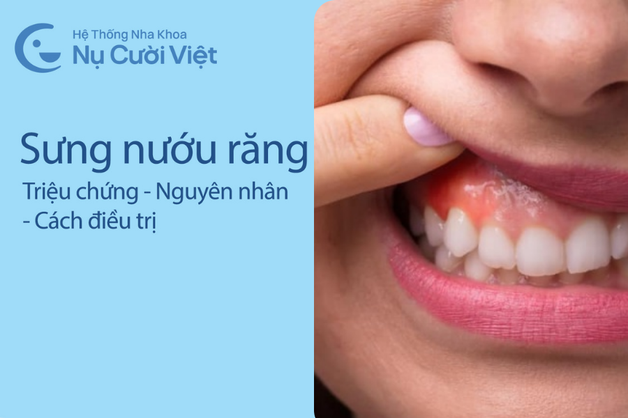 Nụ Cười Việt - Sưng nướu răng: Triệu chứng, nguyên nhân & cách điều trị dứt điểm