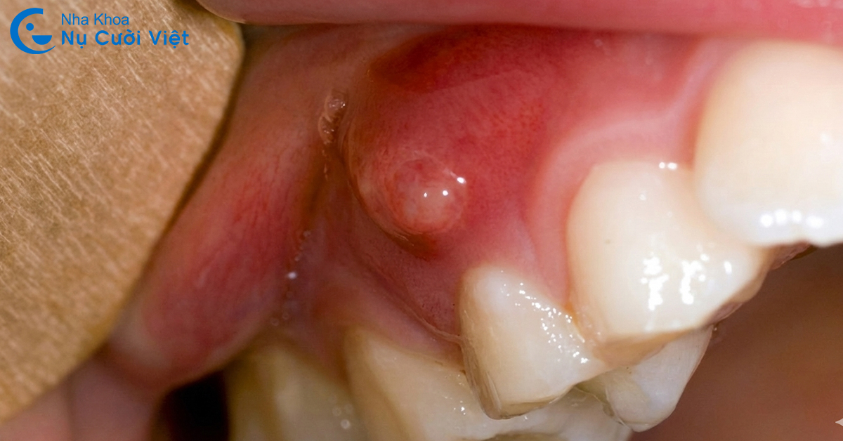 tác hại lấy tủy răng sai cách