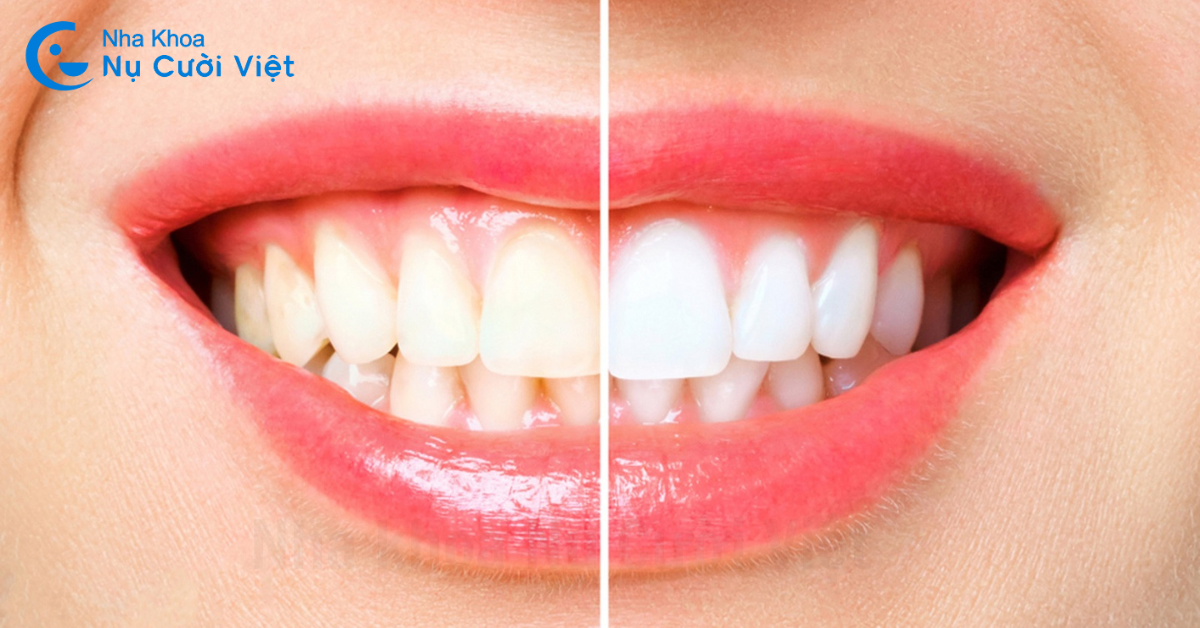 tẩy trắng răng bằng laser là gì