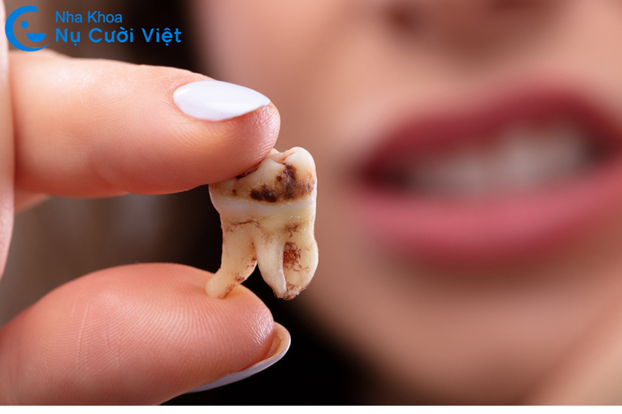 Nụ Cười Việt - NÊN NHỔ RĂNG LÚC NÀO LÀ TỐT NHẤT, THỜI ĐIỂM KHÔNG NÊN NHỔ RĂNG?