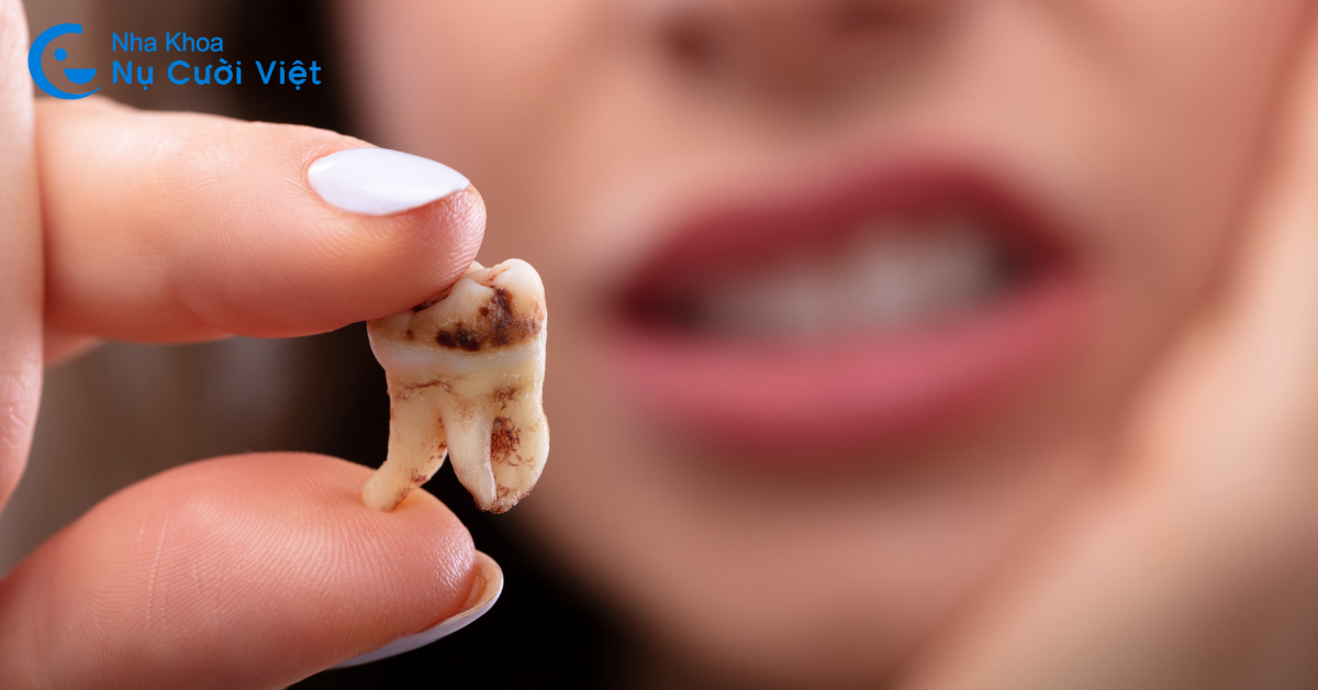 thời điểm nhổ răng tốt nhất an toàn nhất