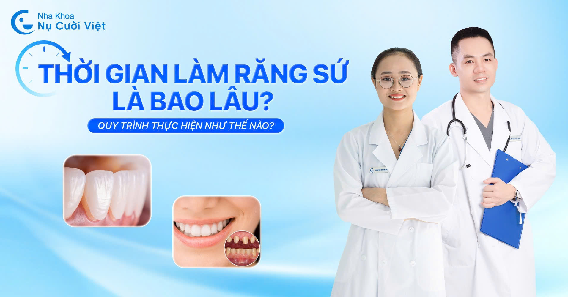 thời gian làm răng sứ là bao lâu