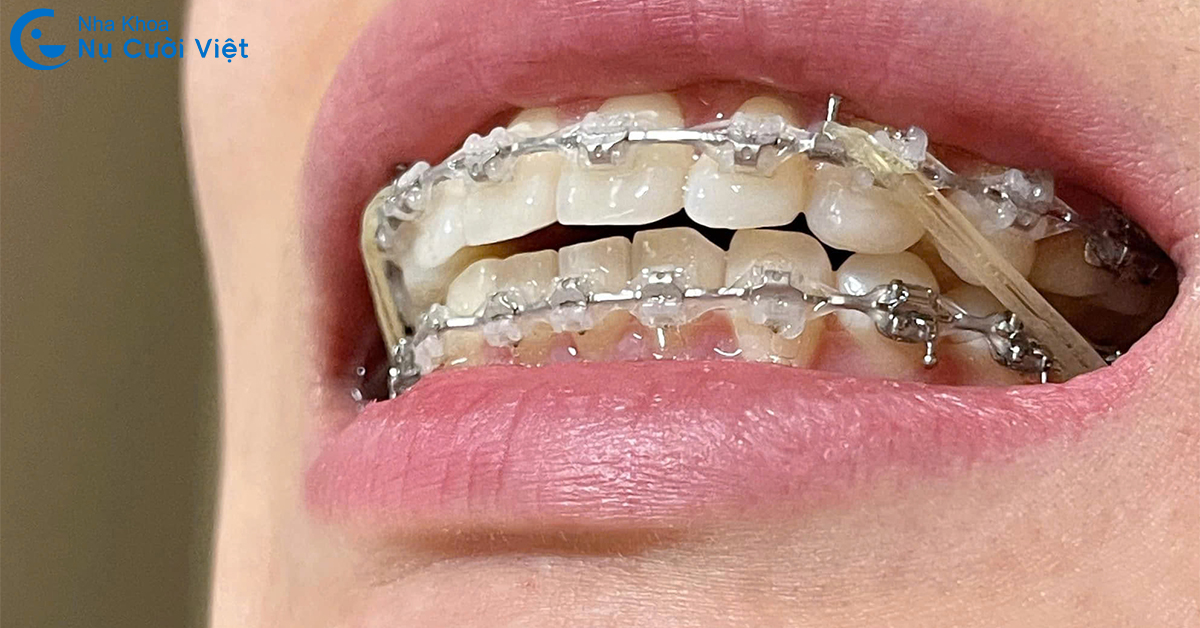 thun niềng răng là gì