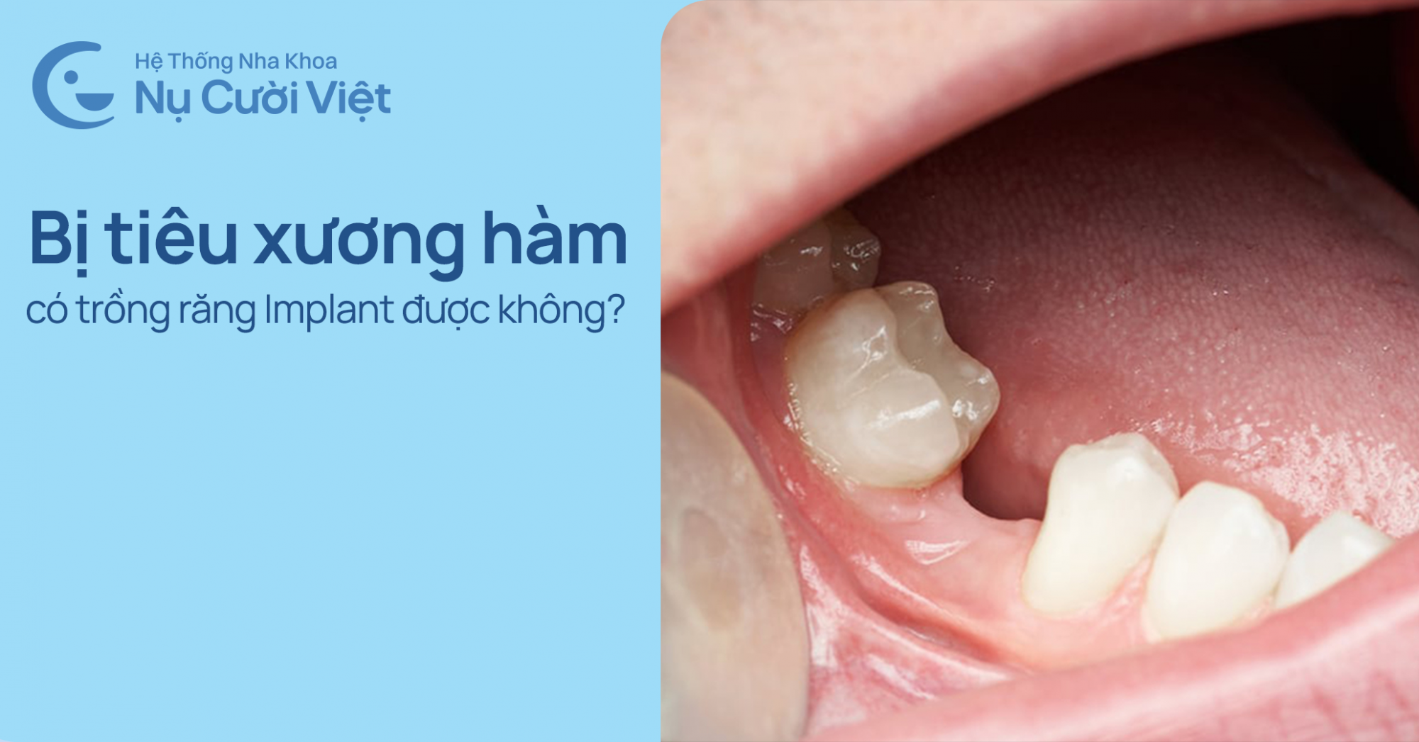 bị tiêu xương hàm có trồng răng implant được không