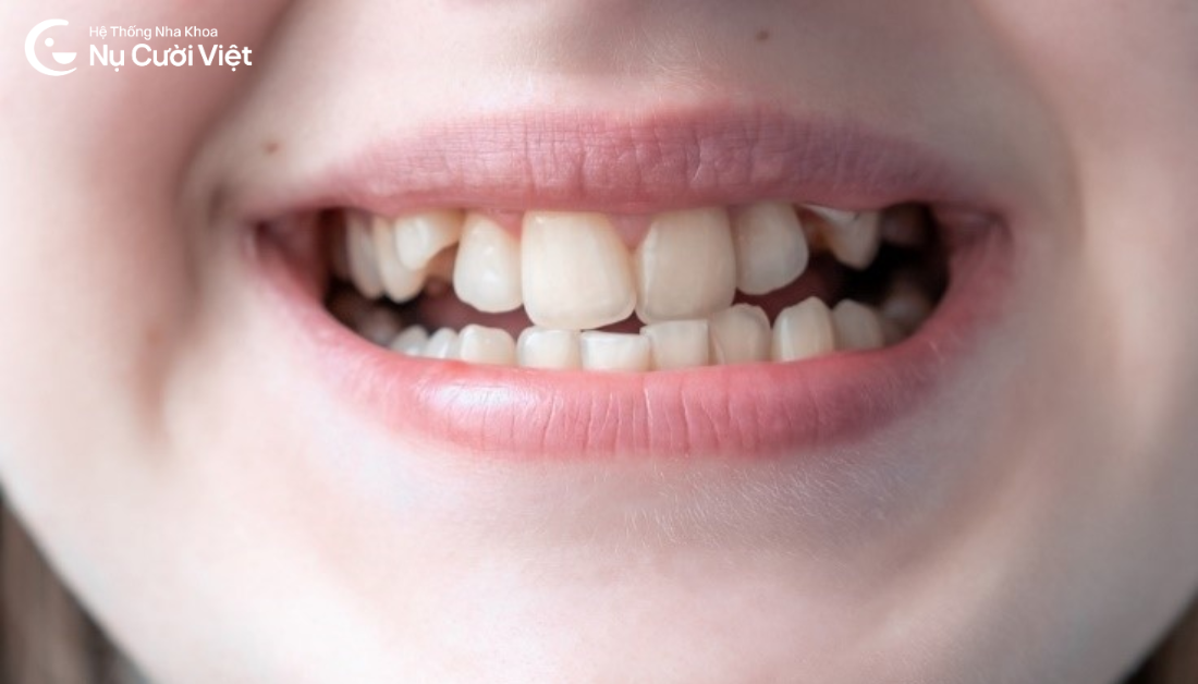 răng khấp khểnh là gì