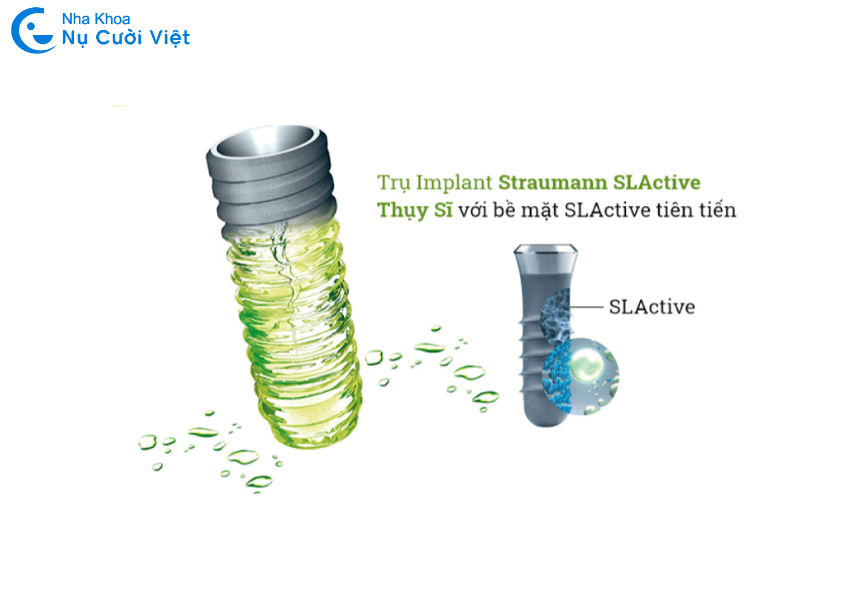 Nụ Cười Việt - Top 7 loại trụ Implant phổ biến, tốt nhất hiện nay