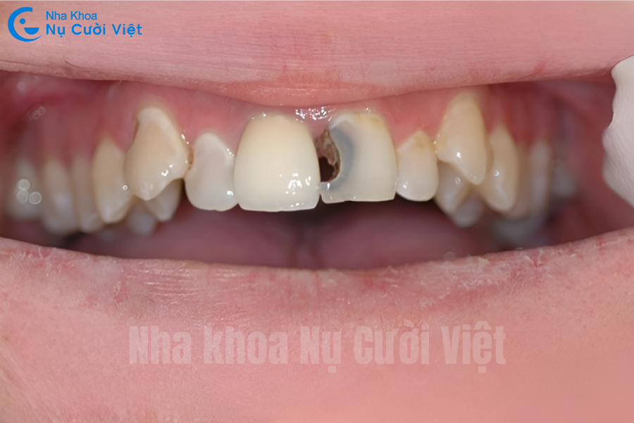 Nụ Cười Việt - TRÁM RĂNG CỬA SÂU CÓ BỀN KHÔNG? CHỌN VẬT LIỆU NÀO ĐỂ DUY TRÌ THẨM MỸ VÀ CHỨC NĂNG LÂU DÀI?