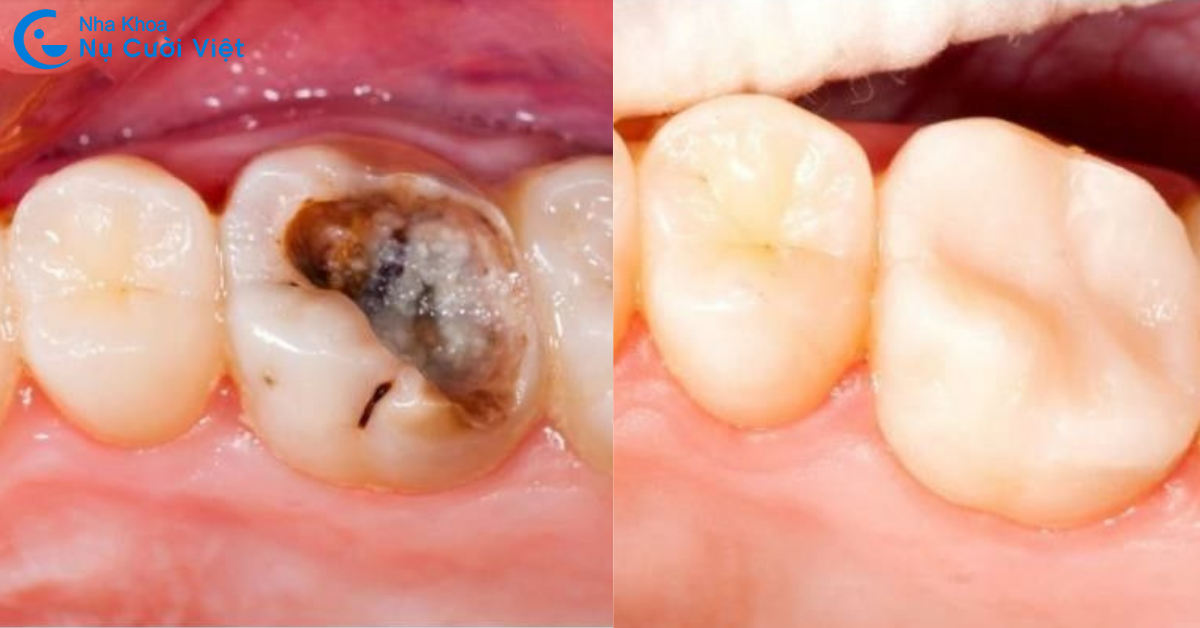 trám răng điều trị răng sâu bị vỡ chỉ còn chân răng