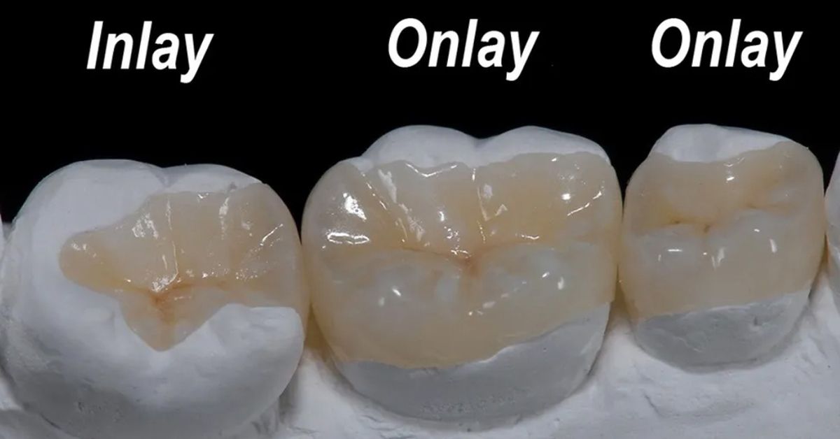 trám răng sau khi chữa tủy