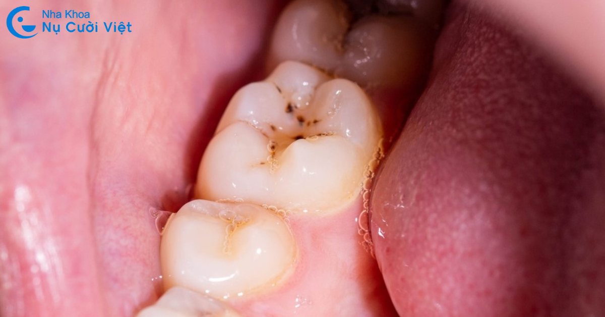 trám răng sữa bị sâu cho trẻ