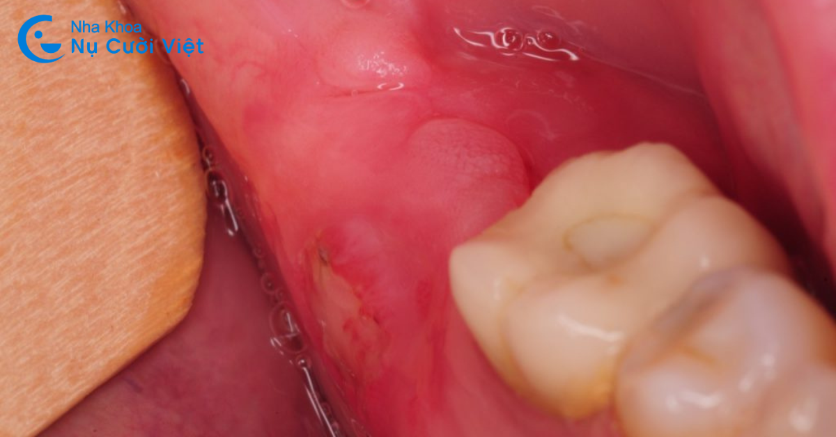 mọc răng khôn có gây nguy hiểm không