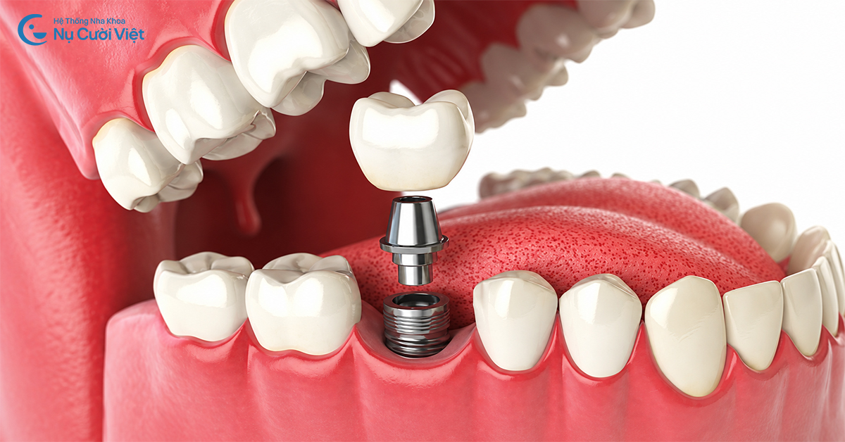 trồng 1 răng bằng cấy ghép implant
