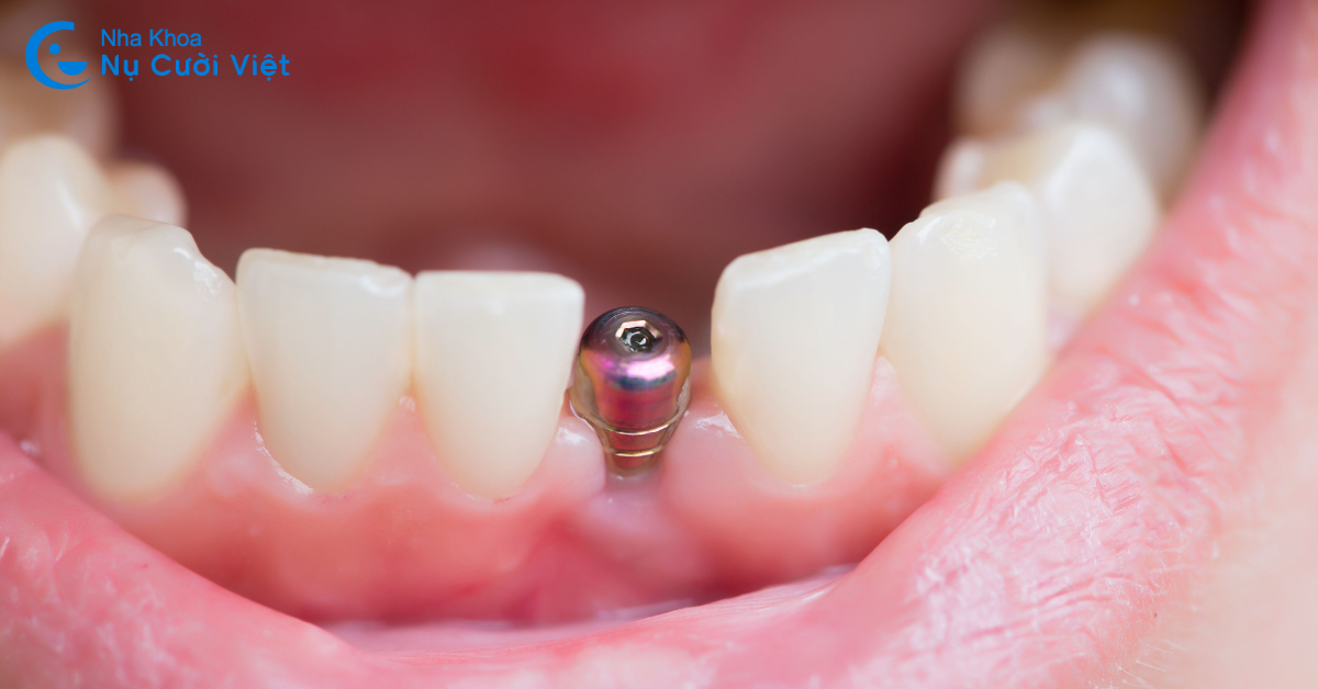 trồng răng implant khắc phục tình trạng mất 1 răng cửa