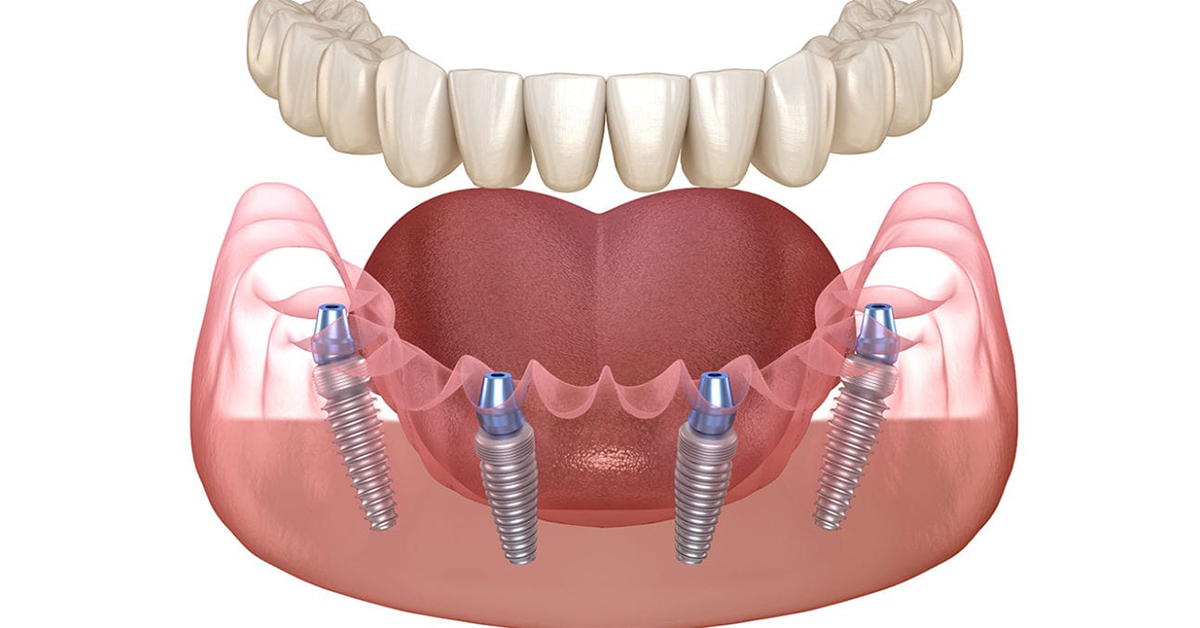 implant toàn hàm cho người già mất răng