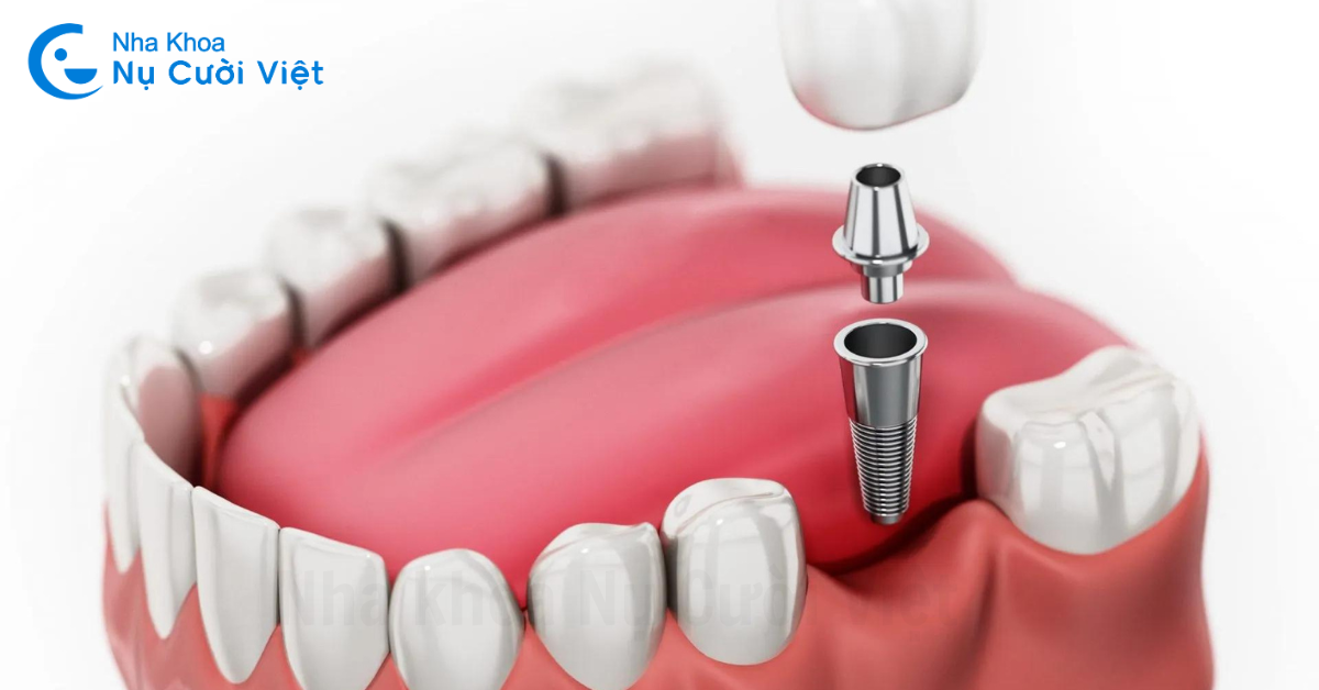 trồng implant cho người già mất răng